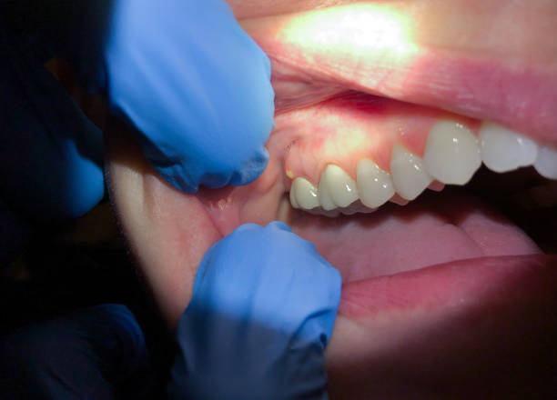 Best Emergency Root Canal Treatment in Lower Lake, CA